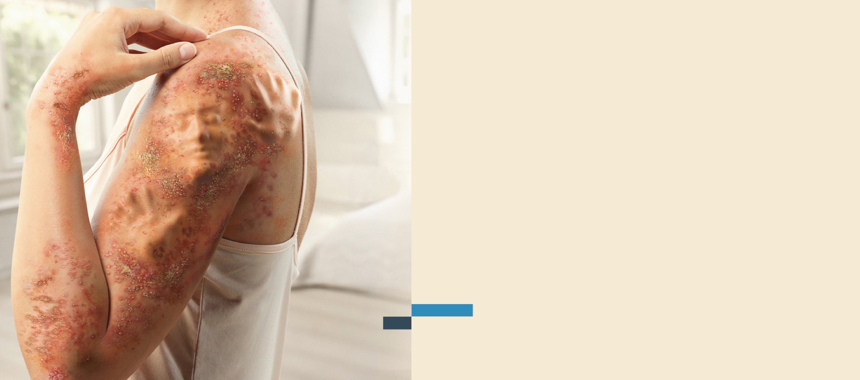 الصدفية البثرية المعممة تجعلك كالسجين